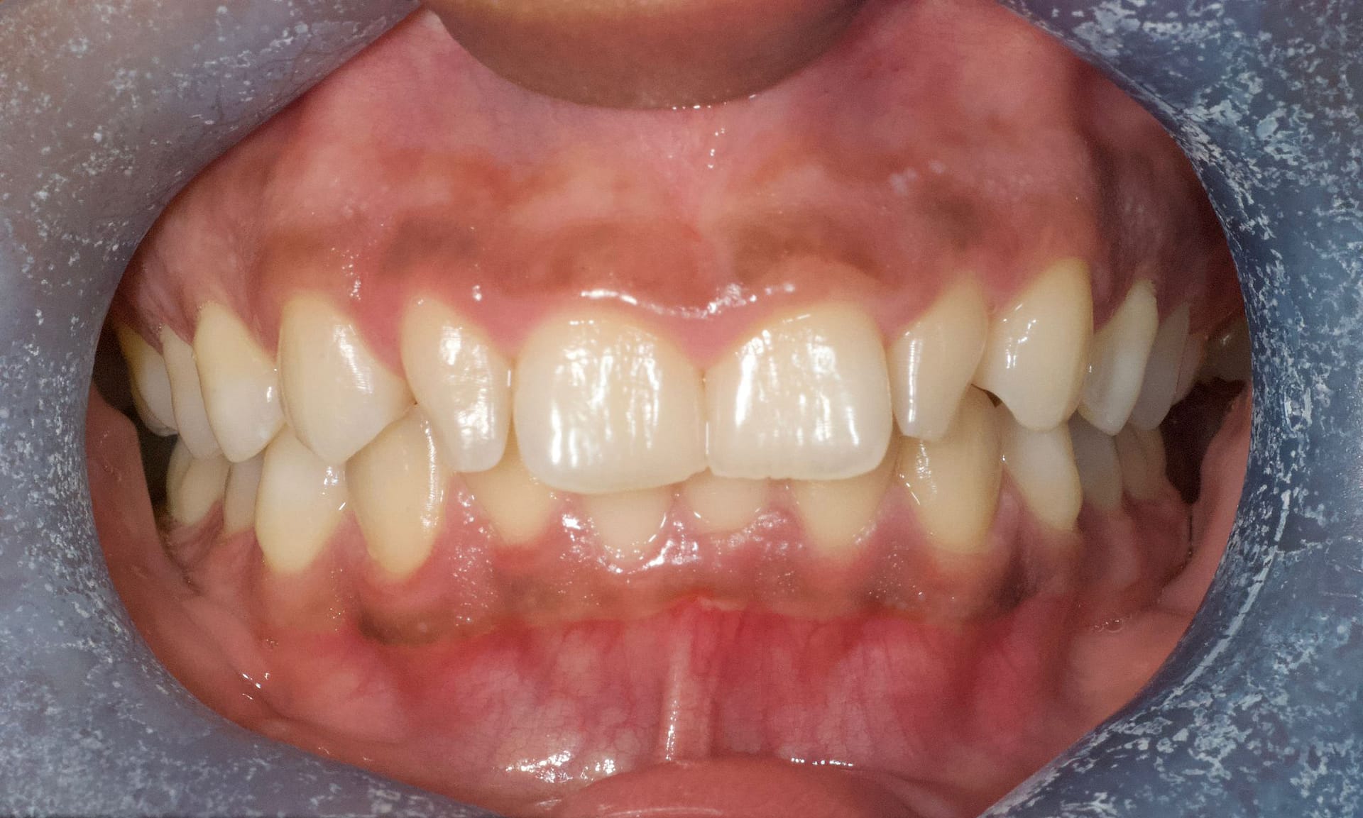 Teeth Whitening Rhodes Street Dental