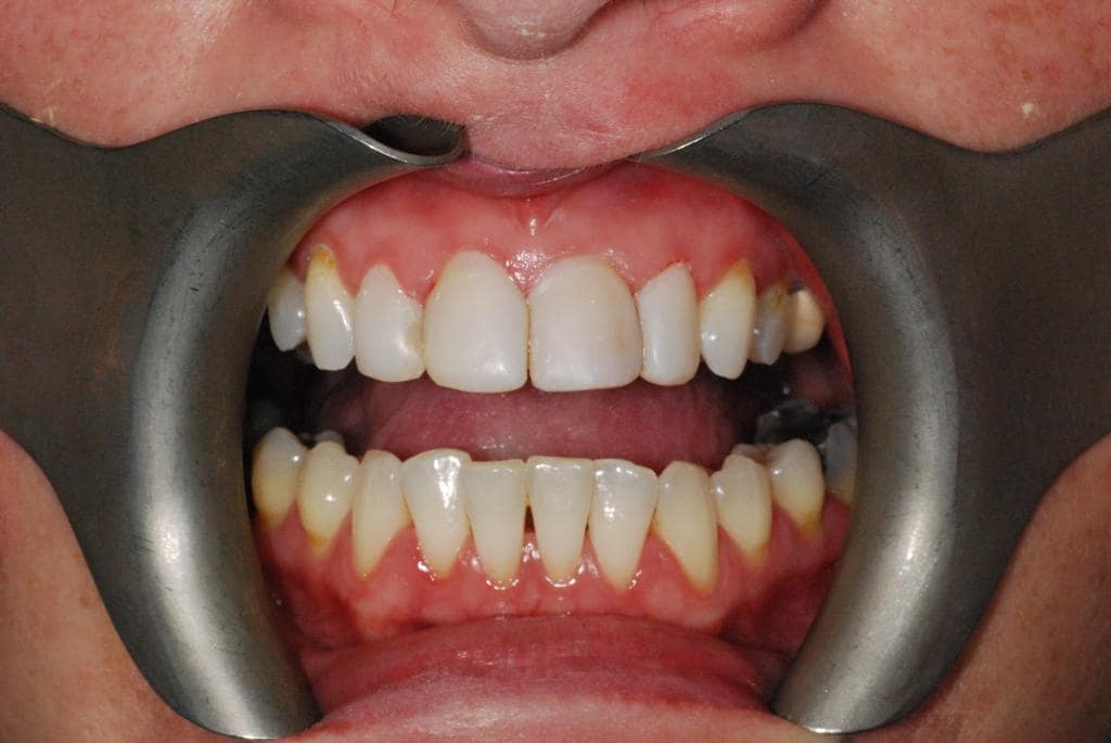 Teeth Whitening Rhodes Street Dental