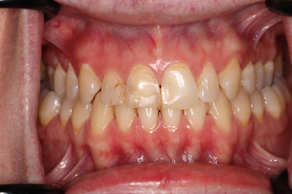 Teeth Whitening Rhodes Street Dental