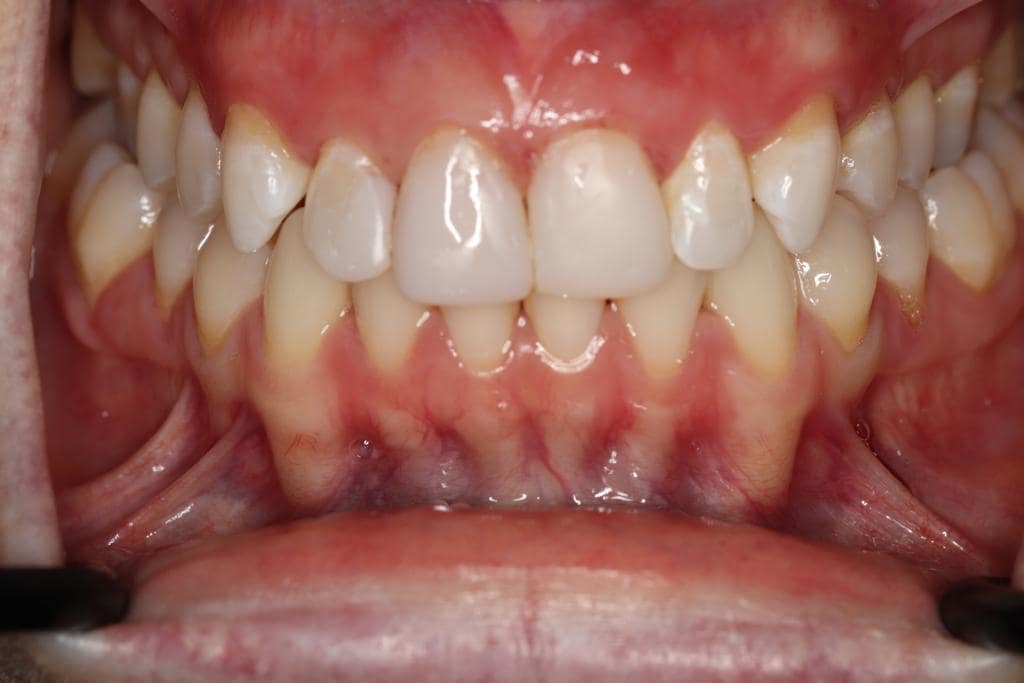 Teeth Whitening Rhodes Street Dental