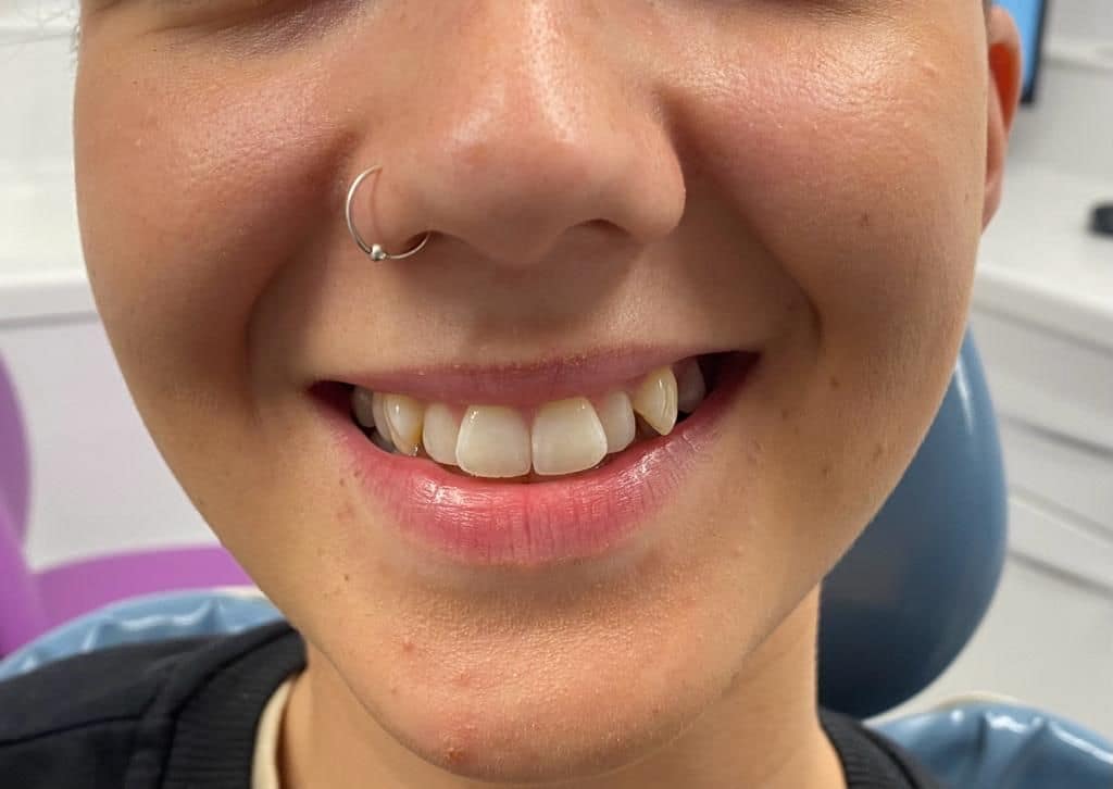 Teeth Whitening Rhodes Street Dental