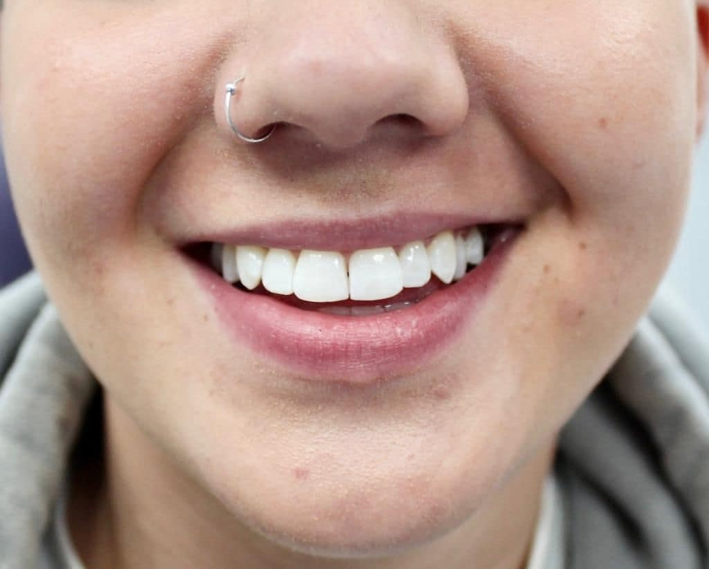 Teeth Whitening Rhodes Street Dental