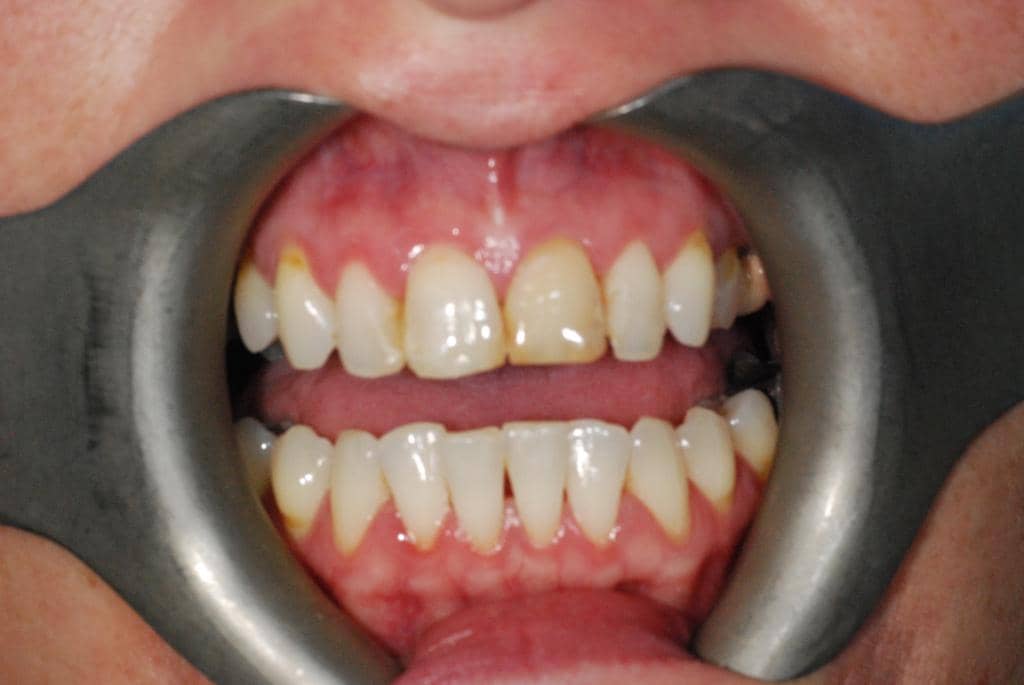 Teeth Whitening Rhodes Street Dental